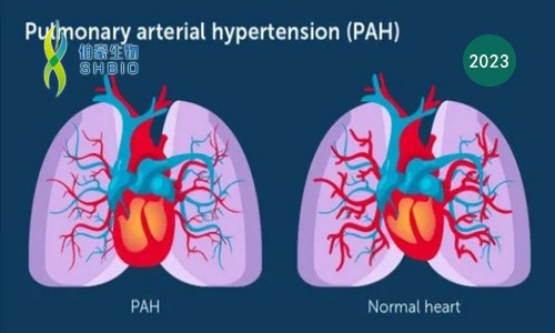 心跳的感覺 |Olink 助力肺動(dòng)脈高壓患者右心室衰竭標(biāo)志物 LTBP- 2 篩選